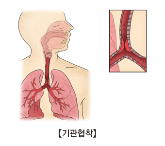 기관 협착