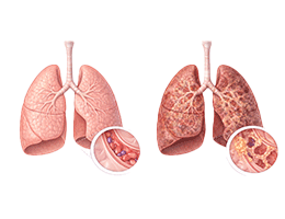 특발성폐섬유증