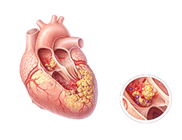 감염성심내막염