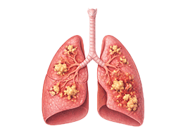 비결핵항산균폐질환