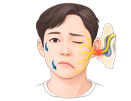 벨 마비