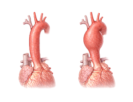 대동맥류(흉부)