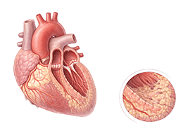 제한성심근병증
