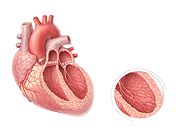 확장형심근병증