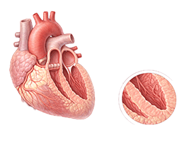 비후성심근병증