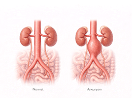 대동맥류(복부)